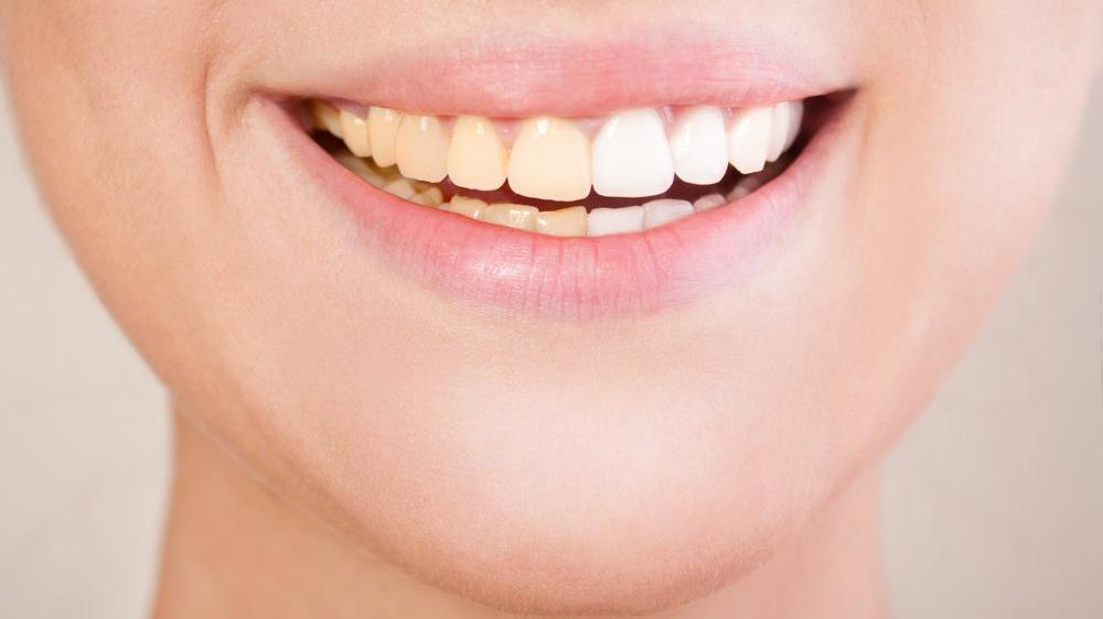 Diş sararmasını önlemek için ne yapmalı?