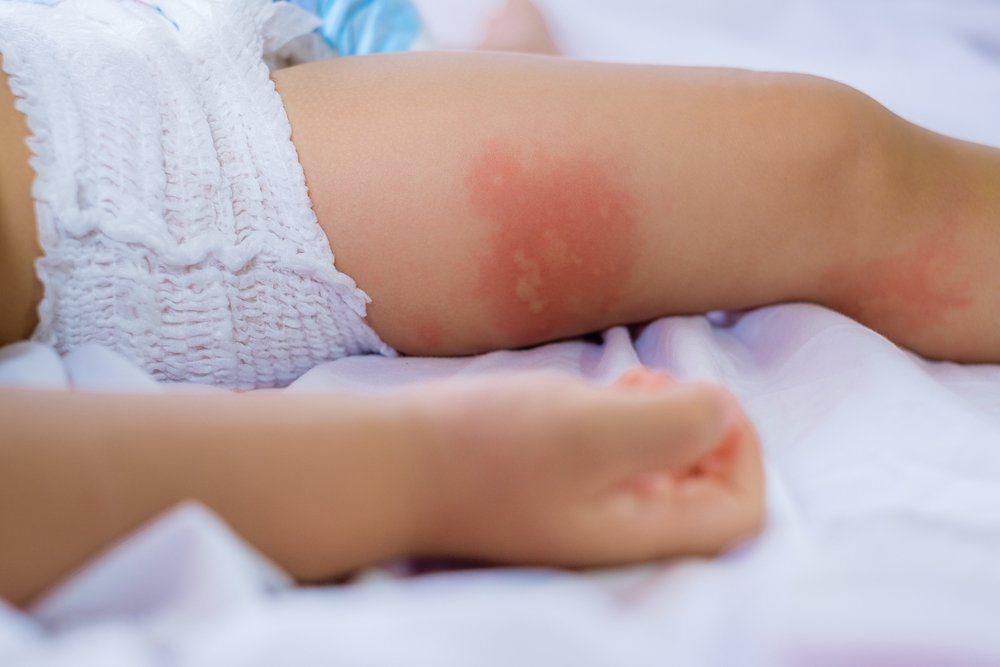 Bebeklerde süt alerjisi belirtileri nelerdir?