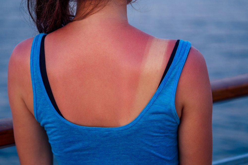 Güneş yanığı acısı nasıl geçer? Güneş yanığı tedavisi…