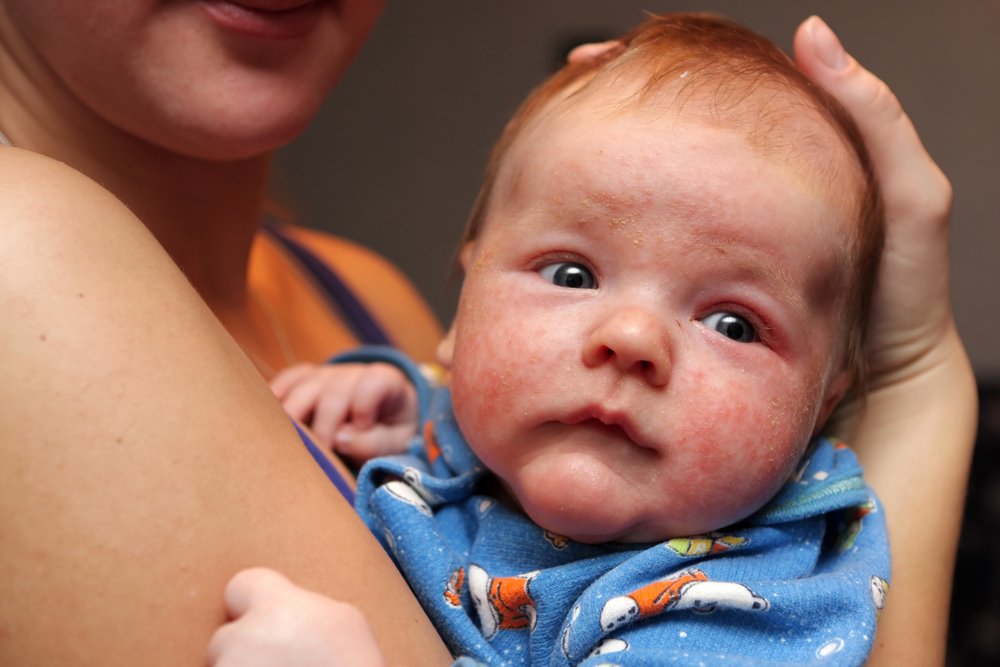 Bebeklerde egzama belirtileri nelerdir? Egzama ne kadar sürede geçer?