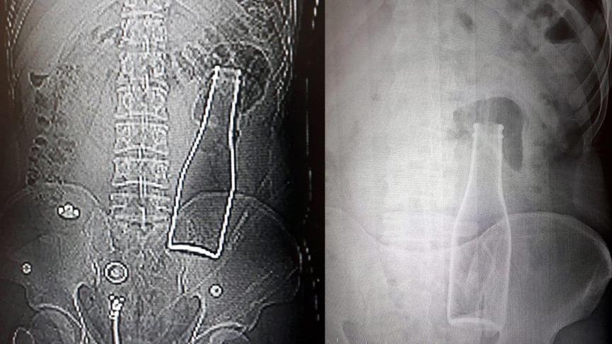 Karaman'da şaşkınlık veren olay: Vücudunda şişe olduğu ortaya çıktı