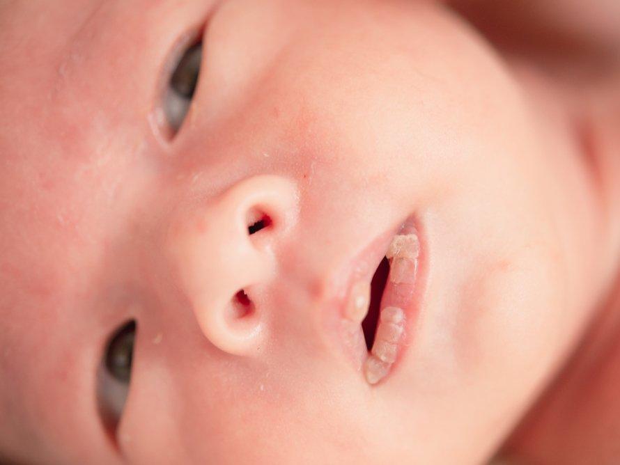 Bebeklerde dudak kuruması neden olur? Bebeklerde dudak kuruluğuna ne iyi gelir?