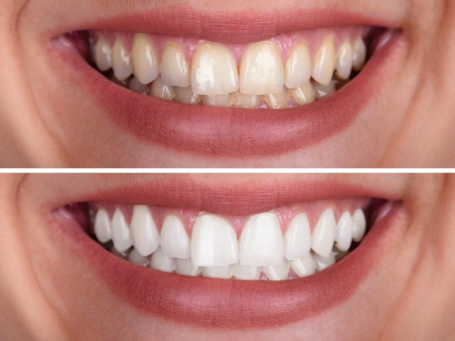Diş renginde sararma neden olur, nasıl önlenir?
