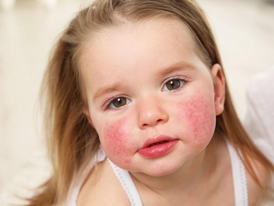 Bebeklerde besin alerjisi belirtileri nelerdir?