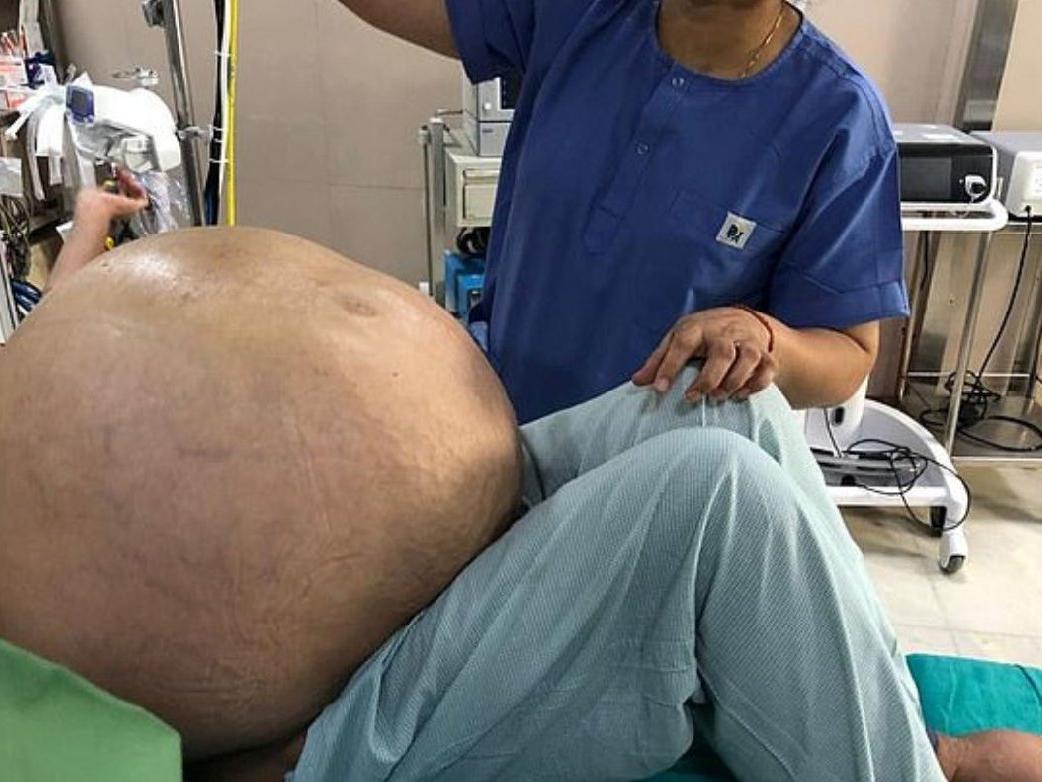 Tıp dünyası şokta: 107 kiloluk tümör çıktı