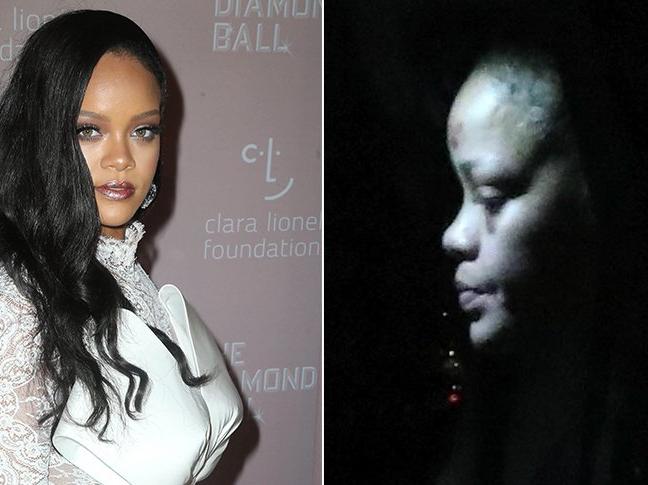 Rihanna'nın yüzündeki morluklar hayranlarını korkuttu