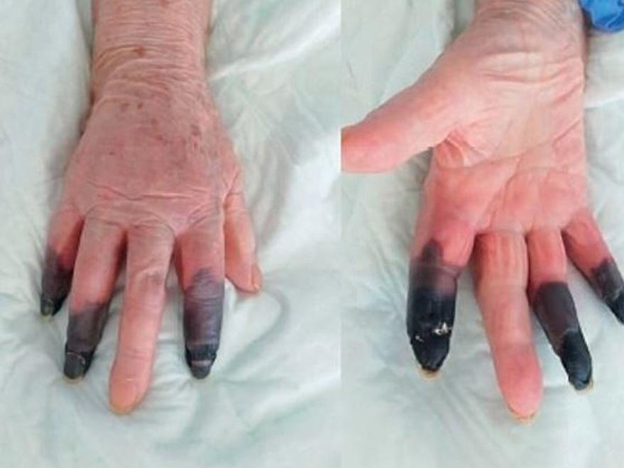 İtalya'da corona virüsü hastasının parmakları kesildi