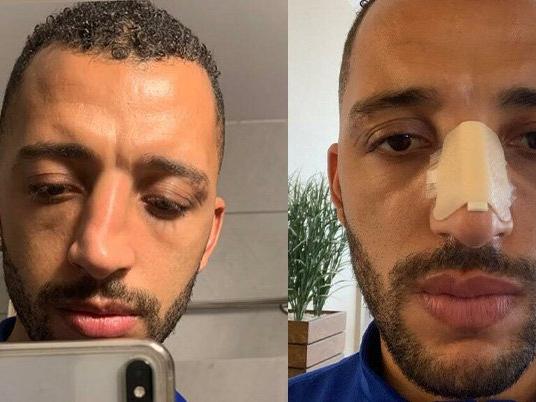 Trabzonsporlu Vitor Hugo paylaştı! 'Dün burnum kırıldı bugün yerine koyduk'