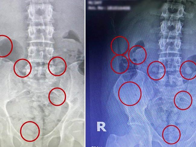 İran uyruklu kişinin mide ve bağırsağındaki uyuşturucu röntgende ortaya çıktı