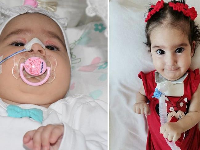 SMA hastası Elif bebek hayatını kaybetti
