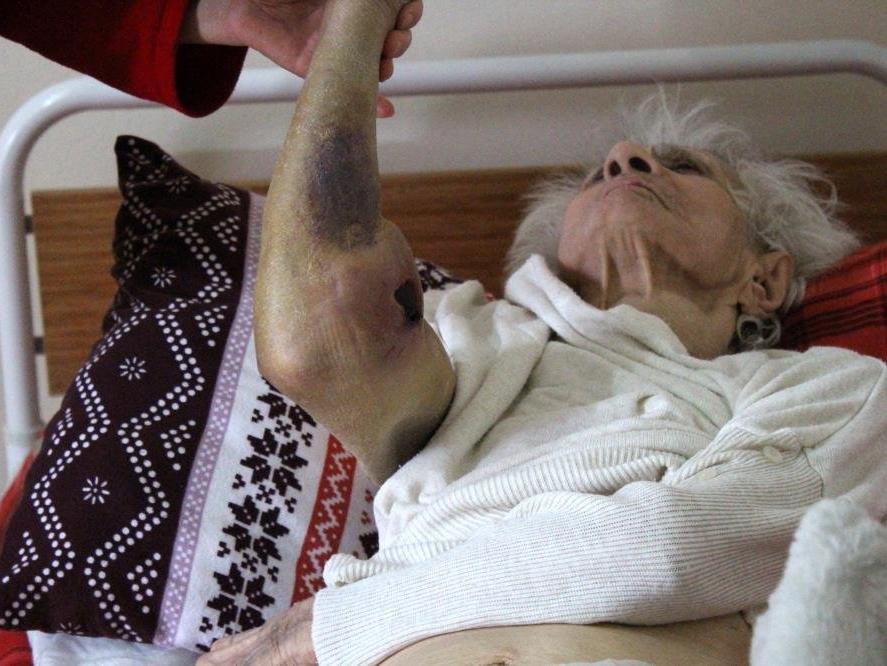 92 yaşında coronayı yenen Suphiye Nine'nin vücudunda oluşan yaralar tedirgin etti