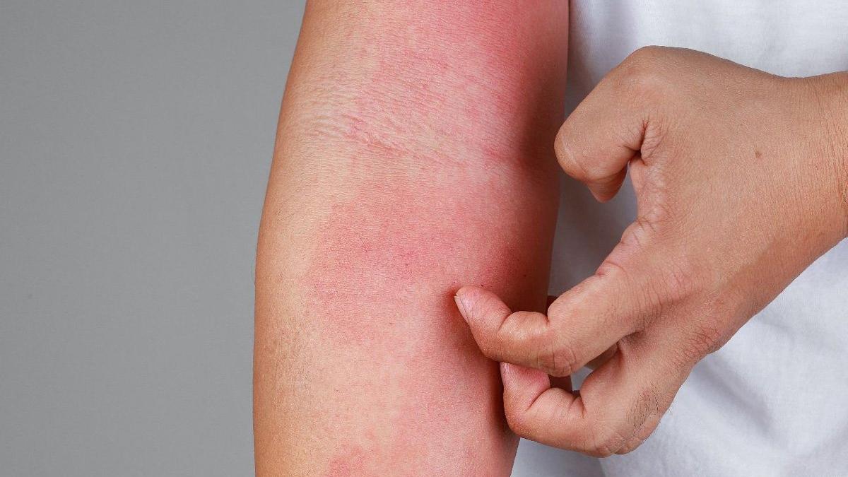 'Pandemide uyuz vakaları yüzde 50 arttı'