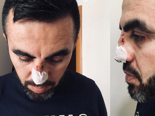 Acil tıp teknikerinin burnunu kıran saldırgan tutuklandı