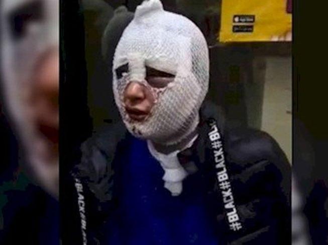 Kız arkadaşının yüzüne kızgın yağ döken Mustafa Resul Erkmen hakkında yeniden yakalama kararı