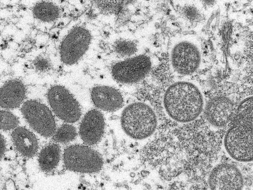 Finlandiya'da ilk maymun çiçeği virüsü vakası doğrulandı