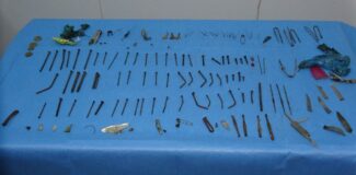 Midesinden 158 parça metal çıktı