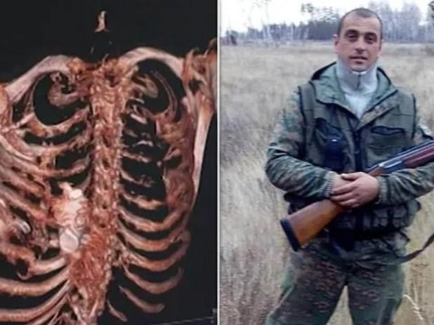 Doktorlar şoke oldu: Patlamamış el bombası Rus askerin göğüs kafesine sıkıştı