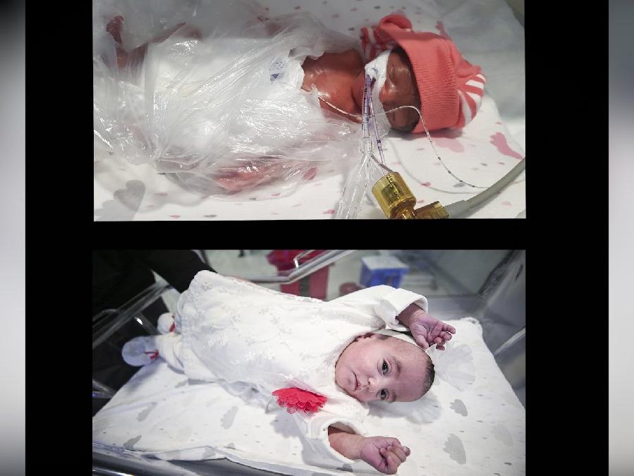 Dünyaya 460 gram gelen bebek 137 günlük mücadeleyle yaşama tutundu