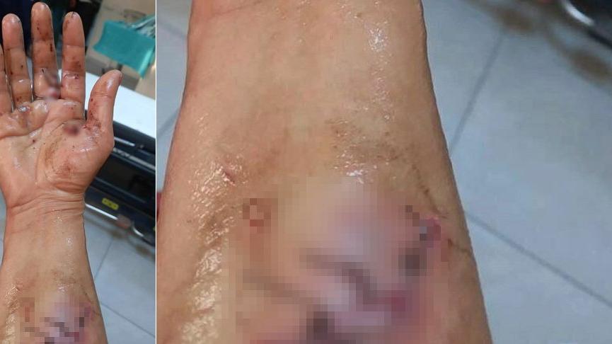 Aydın'da pitbull cinsi köpek kadına saldırdı