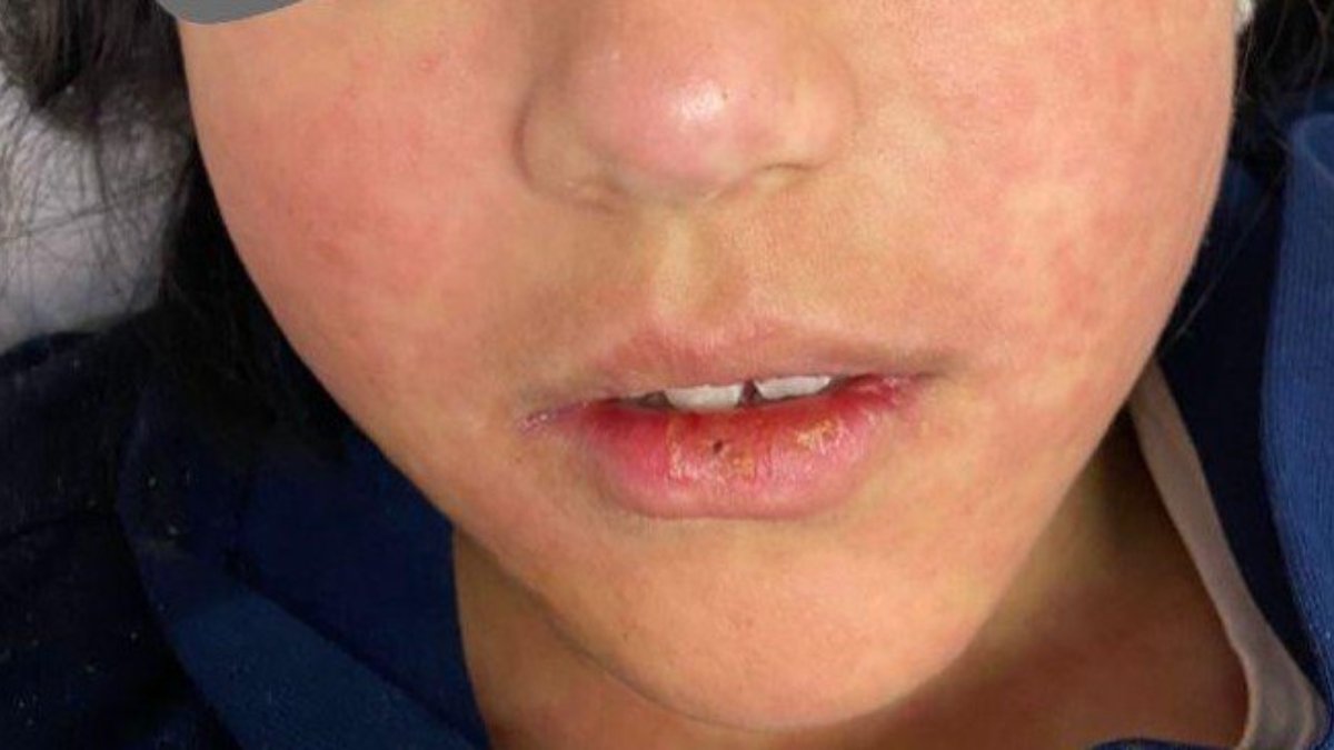 İstanbul'daki kızamık vakası endişe yarattı