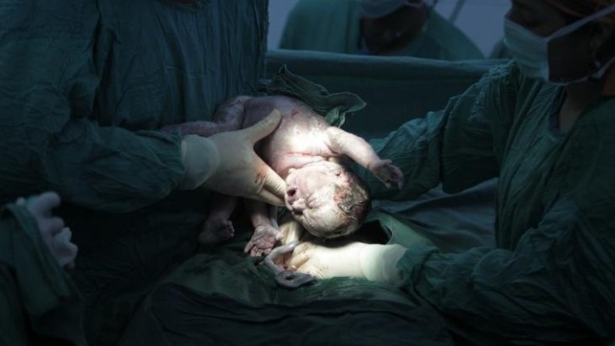 Anne karnındaki bebeğe beyin ameliyatı