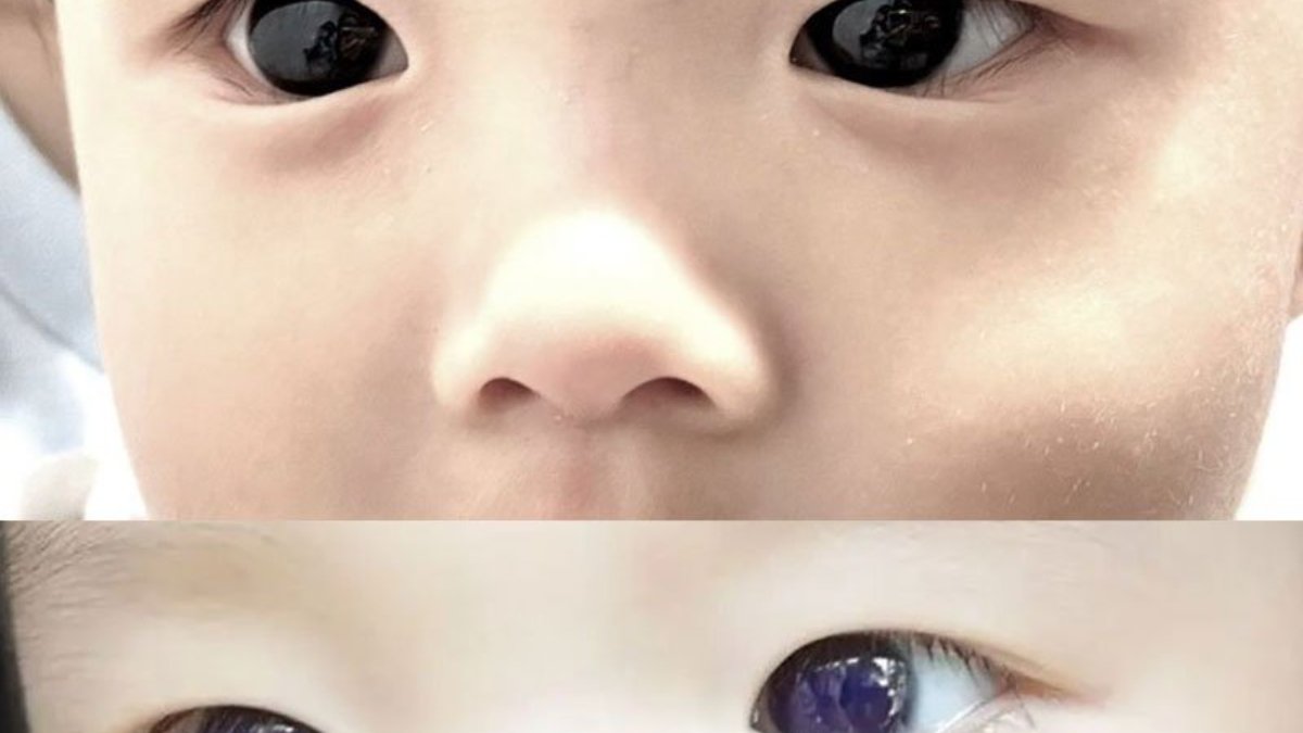 Covid-19 tedavisi olan bebeğin gözü kahverengiden parlak maviye döndü