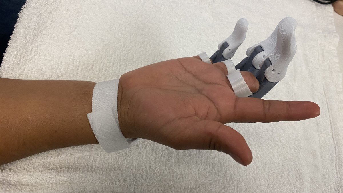 3D yazıcı ile parmak protezi yaptılar